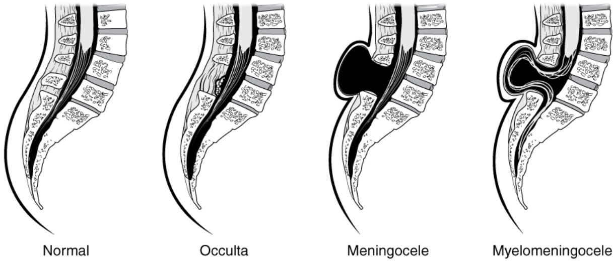Understanding Spina Bifida: Four Types