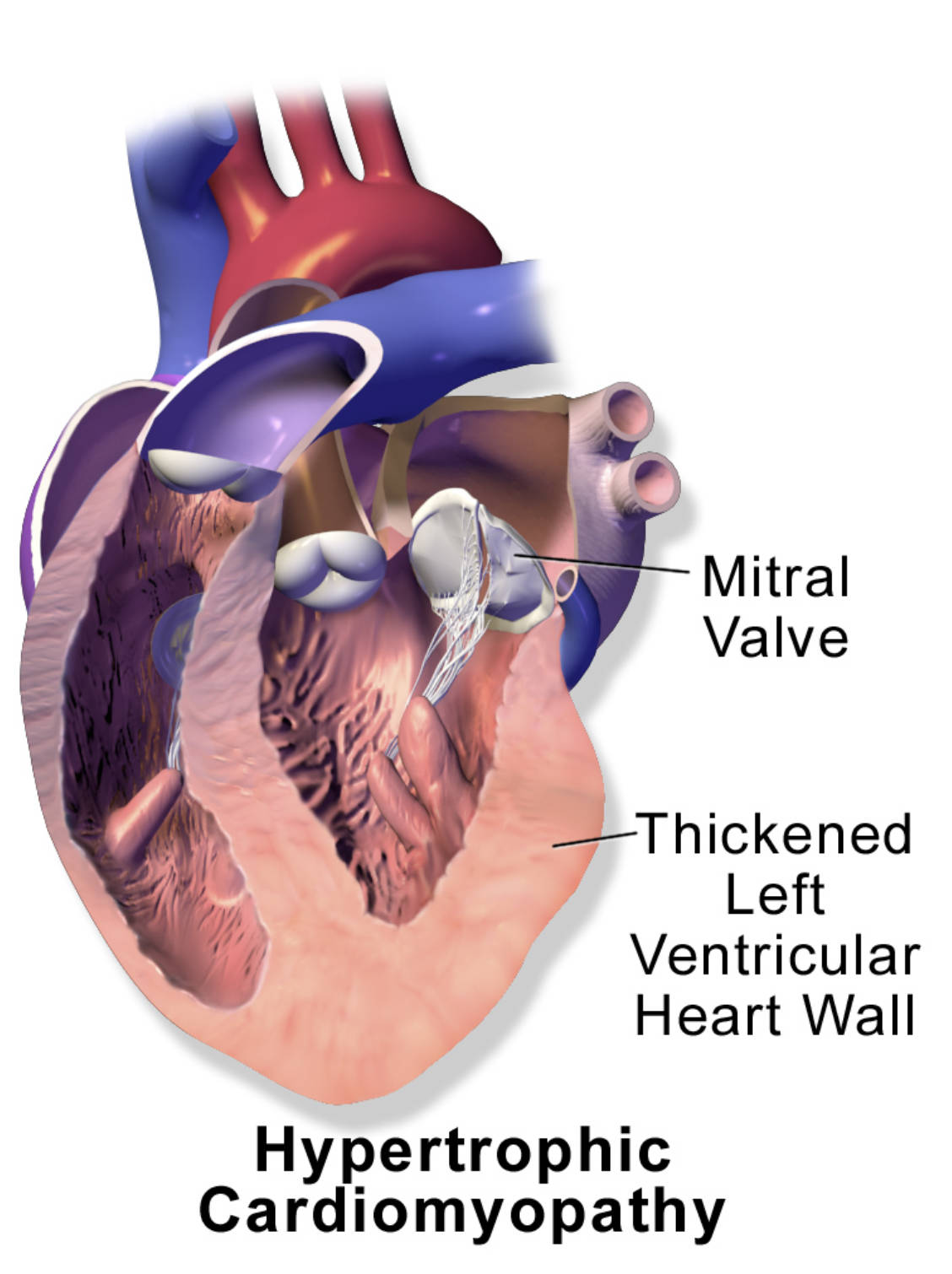 Hypertrophic Cardiomyopathy: Understanding the Thickened Heart Muscle