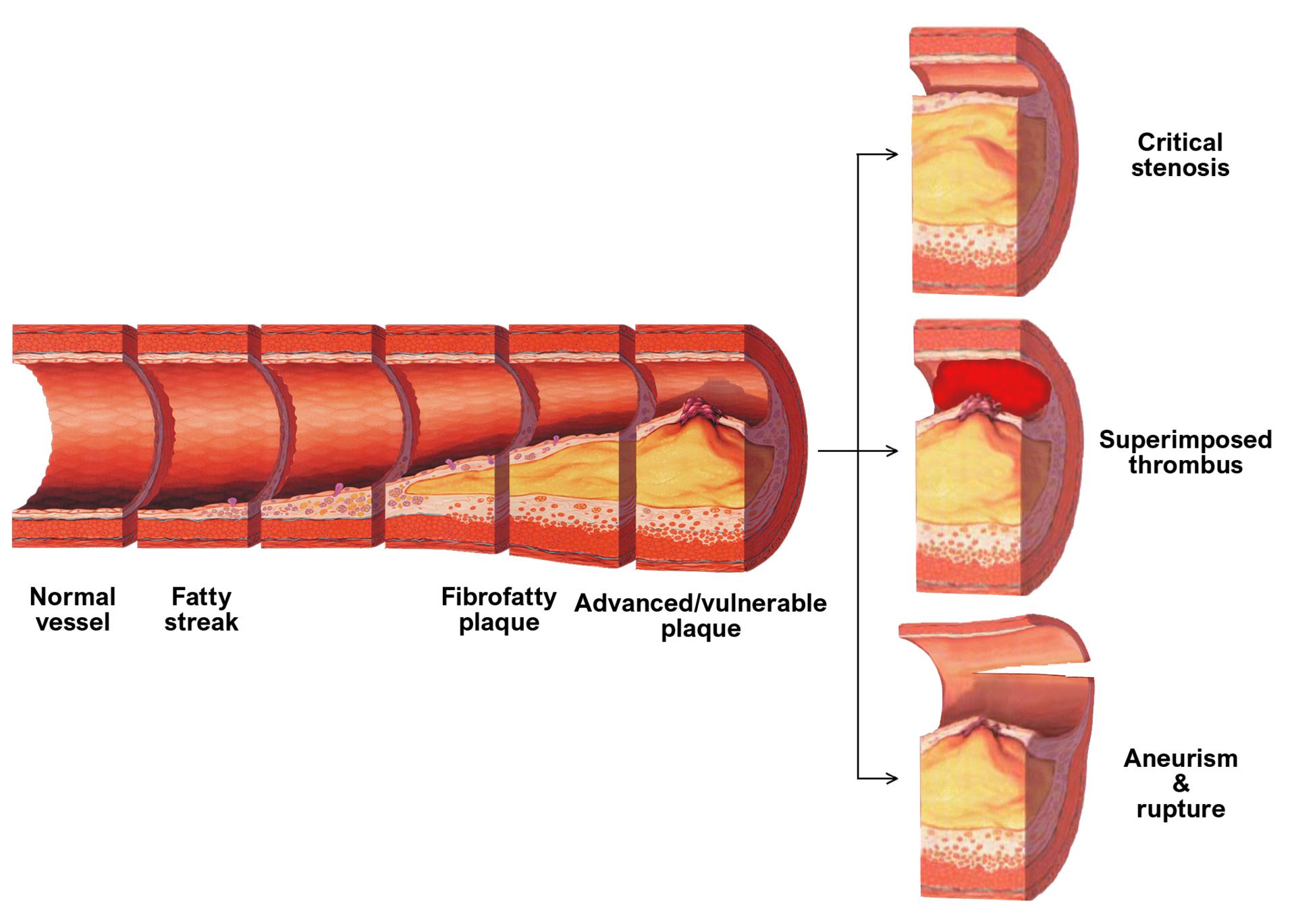 Understanding Late Complications of Atherosclerosis: A Comprehensive Guide