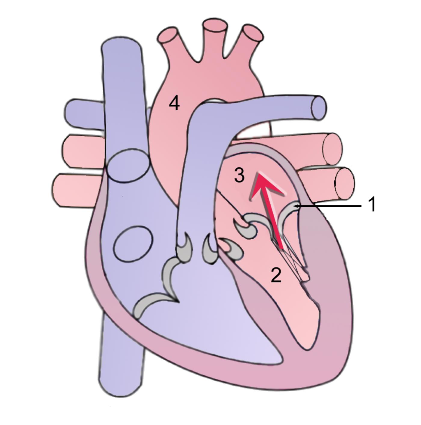 Mitral Regurgitation: Understanding the Impact of a Leaky Mitral Valve