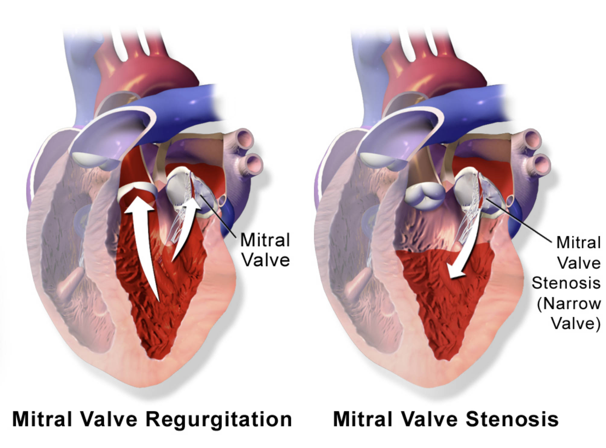 Understanding Mitral Valve Disease: Regurgitation vs. Stenosis