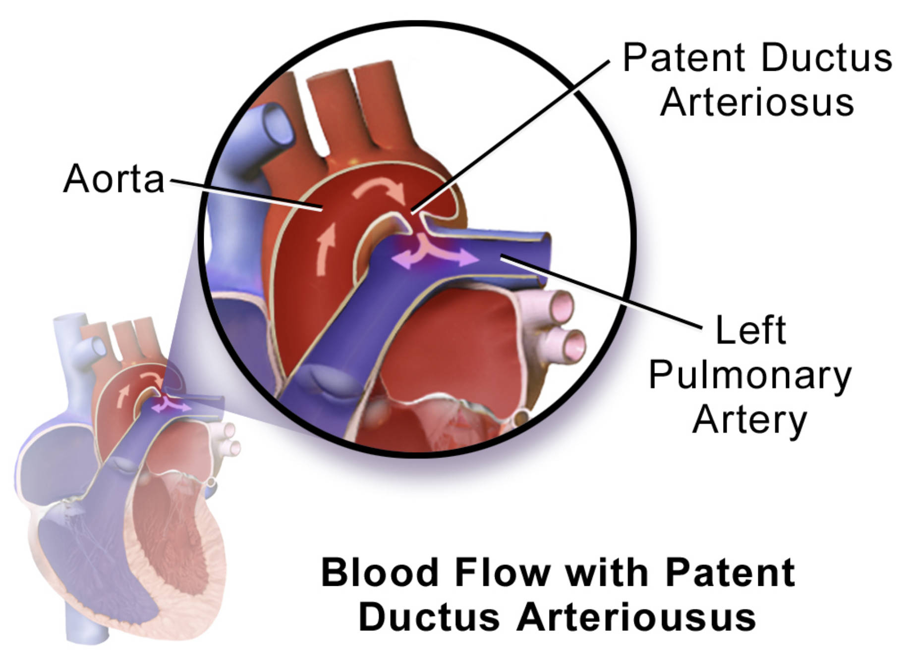 Patent Ductus Arteriosus: Understanding Abnormal Blood Flow in the Newborn Heart