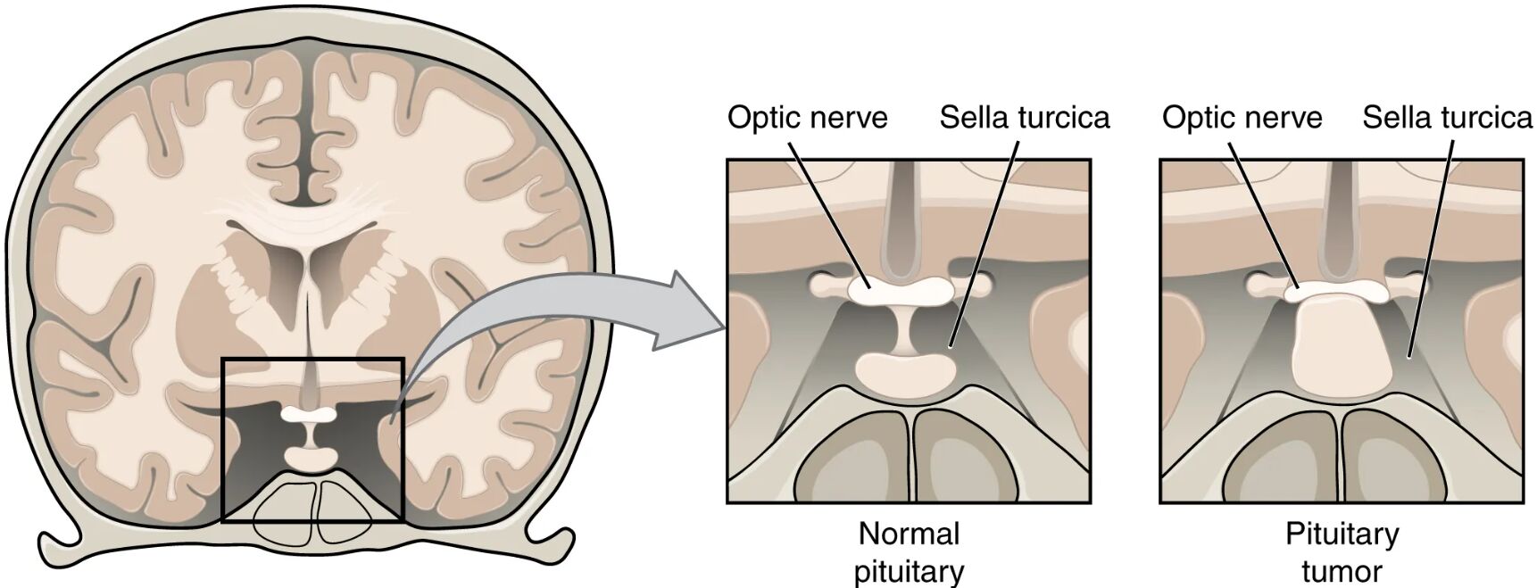 Pituitary Tumor: Anatomy and Impact Illustrated
