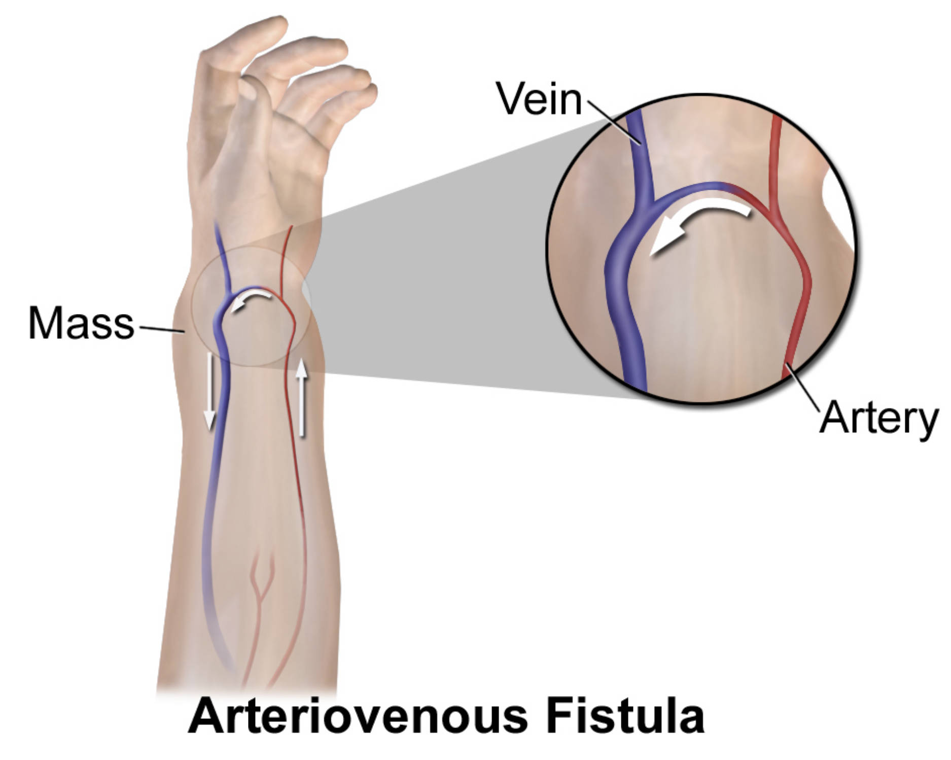 arteriovenous-fistula Understanding Arteriovenous Fistula: Causes, Symptoms, and Management