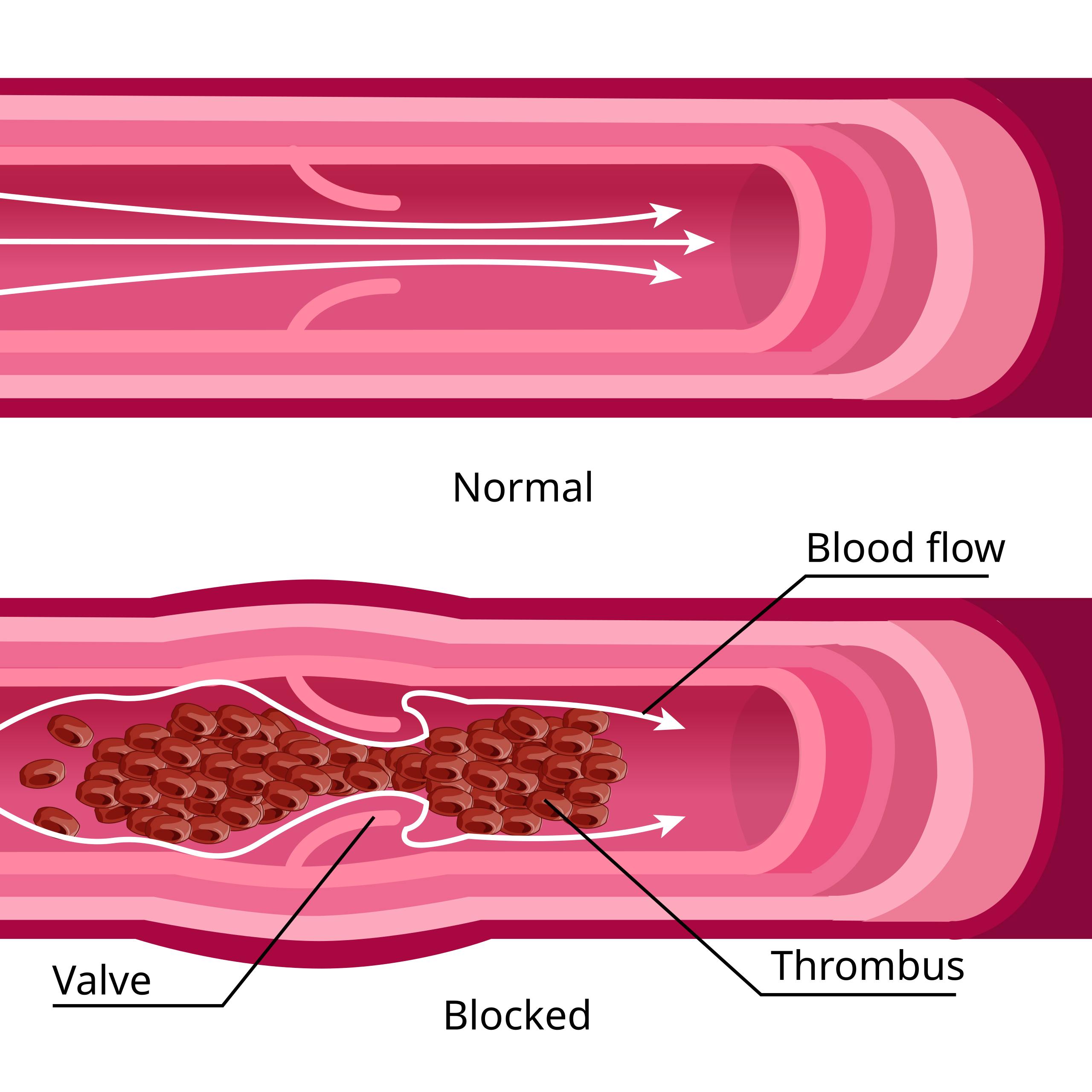 Venous Thrombosis Anatomy: How Blood Clots Form Around Valves