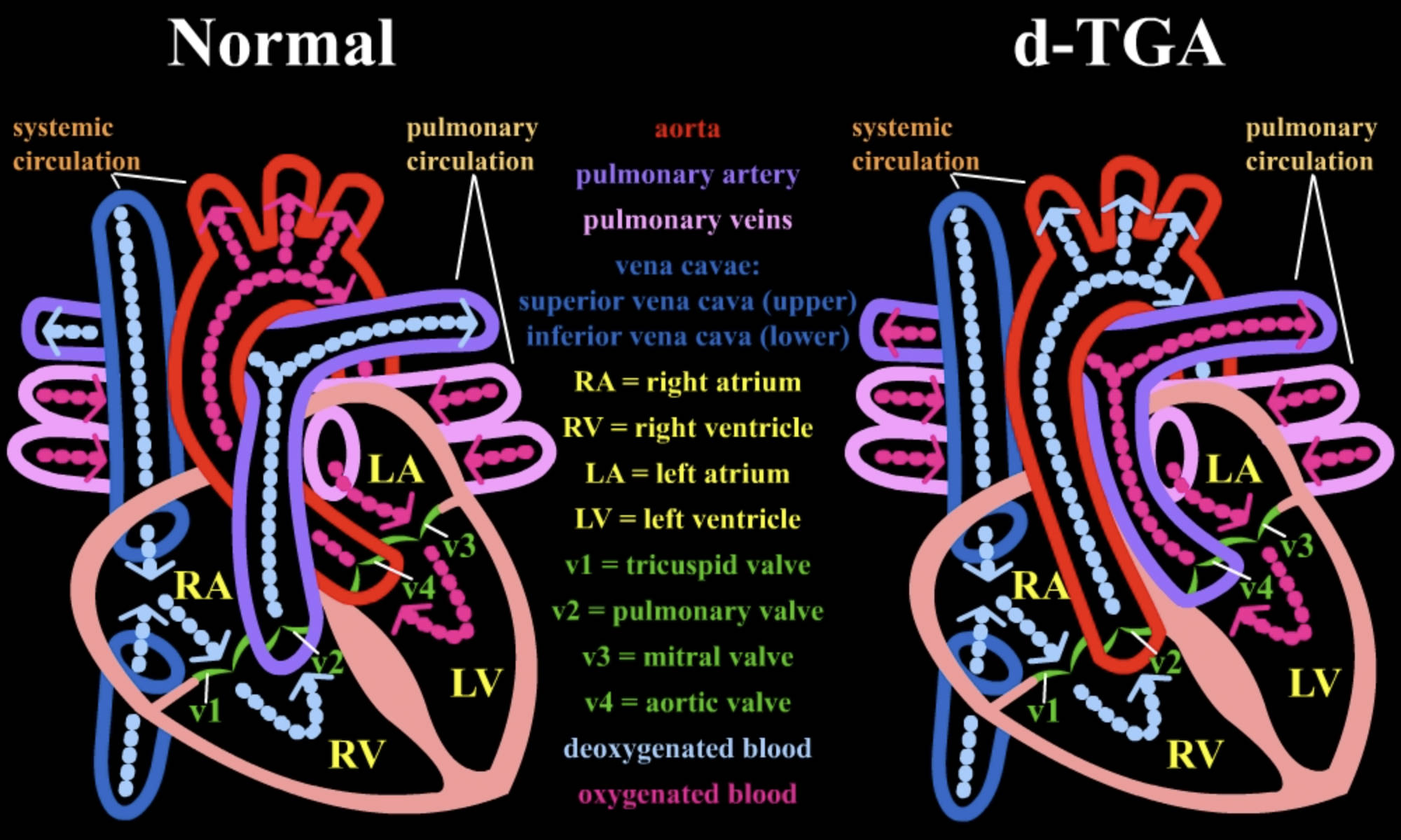Comparing Normal Cardiac Circulation to Dextro-Transposition of the Great Arteries (d-TGA)