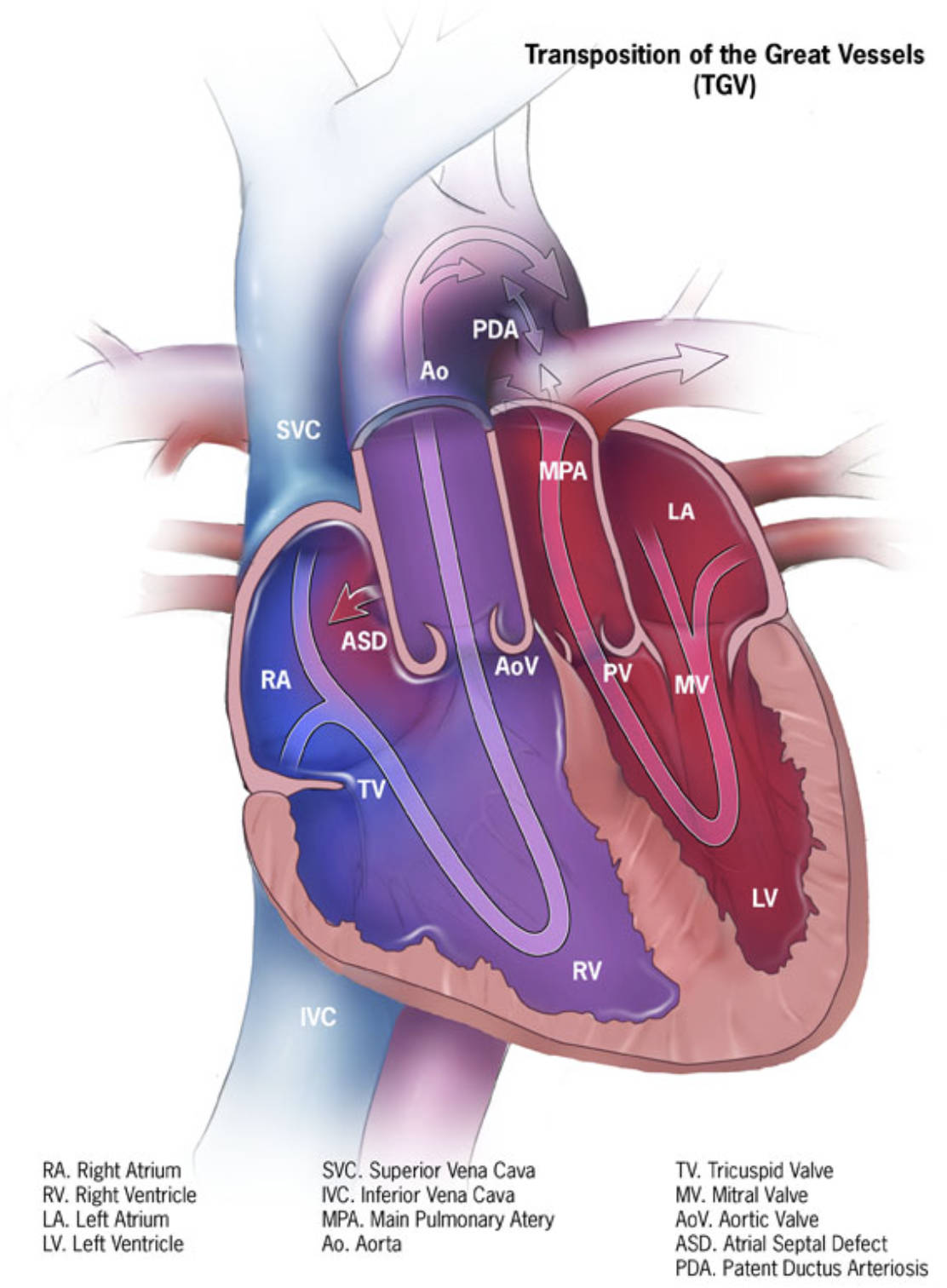 Understanding Dextro-Transposition of the Great Arteries (d-TGA): Anatomy and Pathophysiology