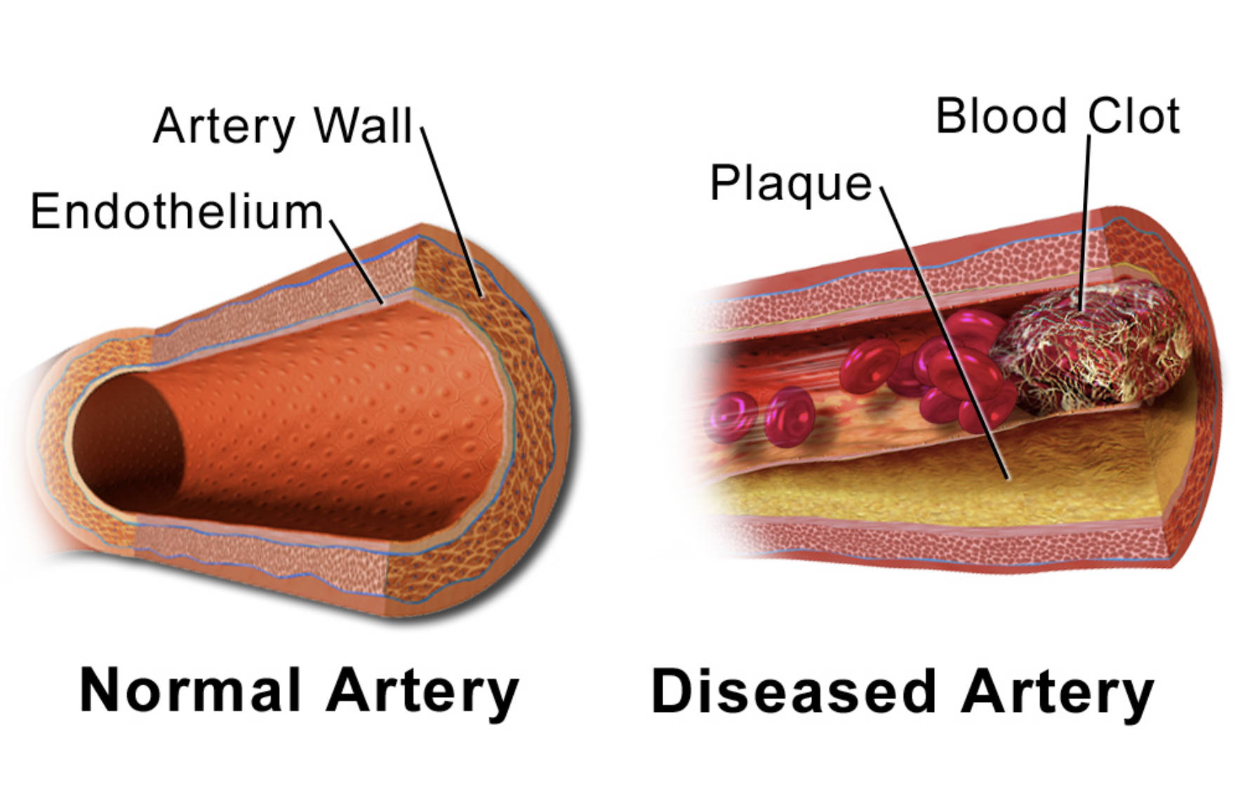 Atherosclerosis and Arterial Health: Comparing Normal vs. Diseased Vessels