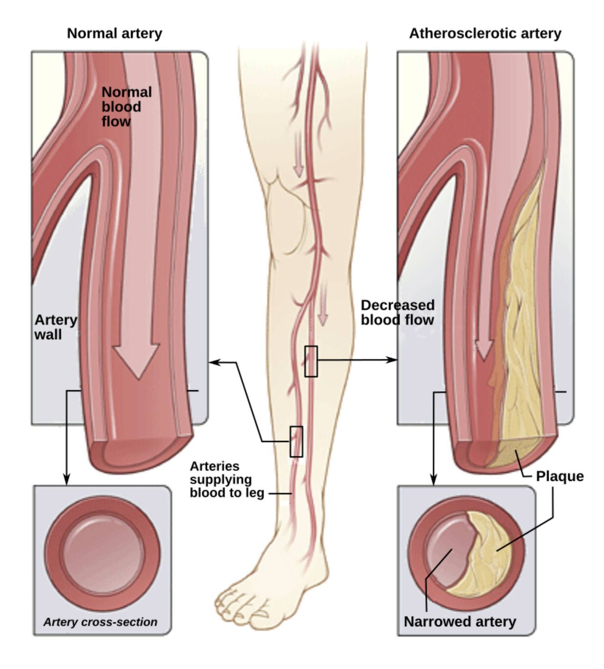 Understanding Peripheral Arterial Disease: Anatomy of Atherosclerosis in the Lower Limbs
