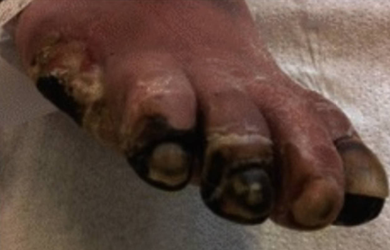 Peripheral Arterial Disease and Digital Necrosis: Causes, Progression, and Management