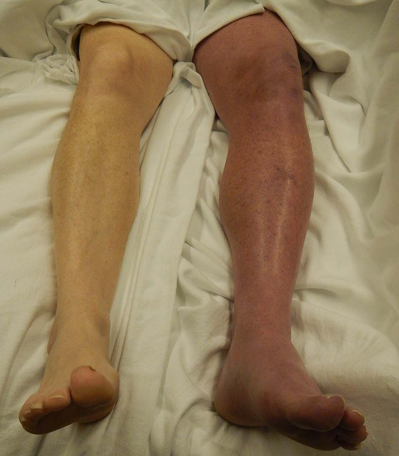 Phlegmasia Cerulea Dolens: Understanding Severe Deep Vein Thrombosis and Limb Ischemia