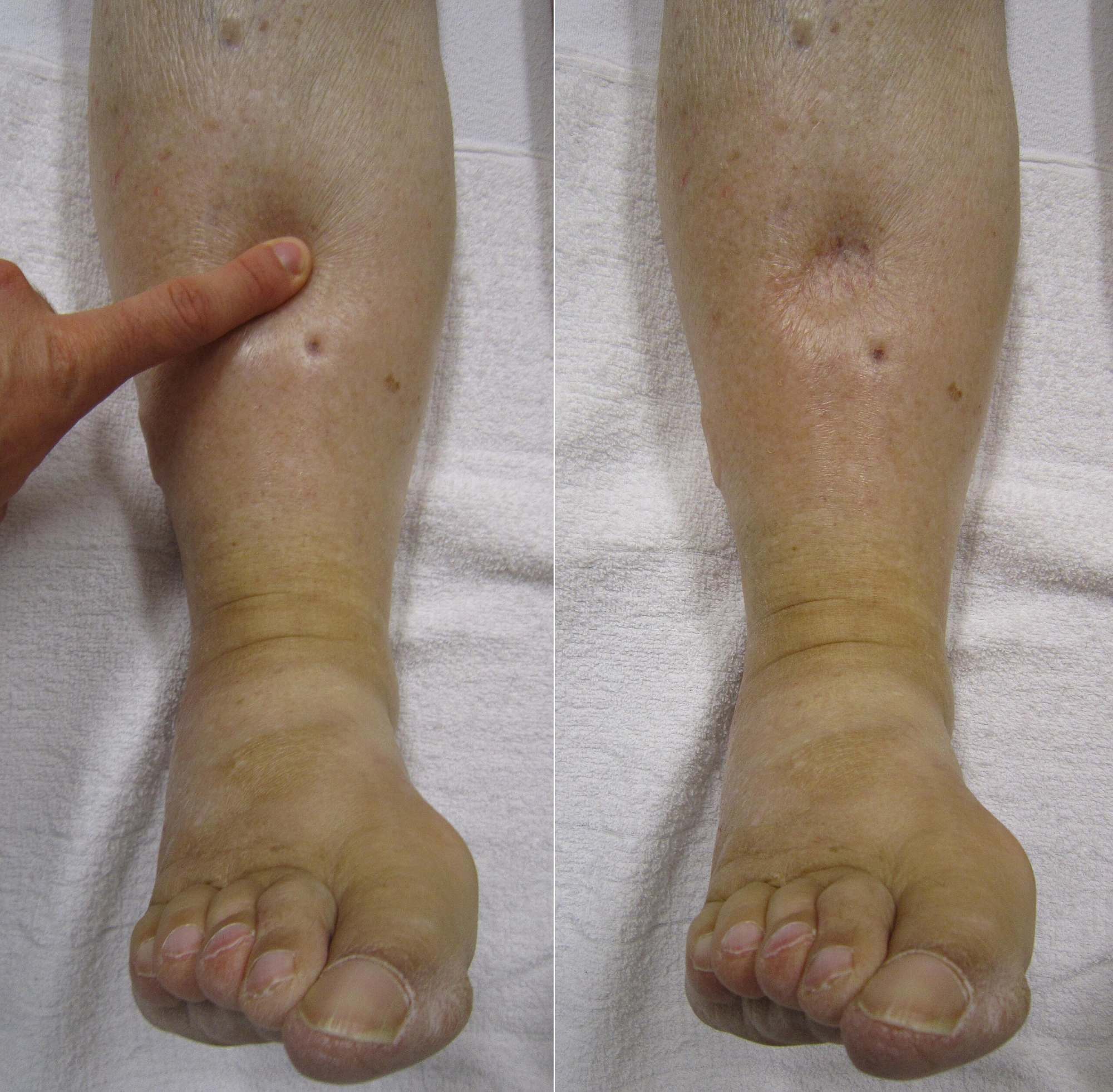 Pitting Edema: Clinical Assessment, Causes, and Pathophysiology