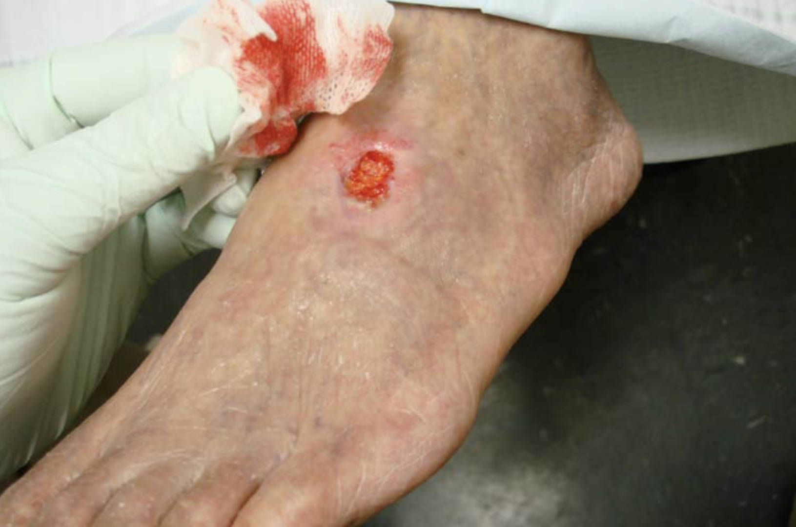Peripheral Arterial Disease and Chronic Foot Ulcers: Causes, Risks, and Management