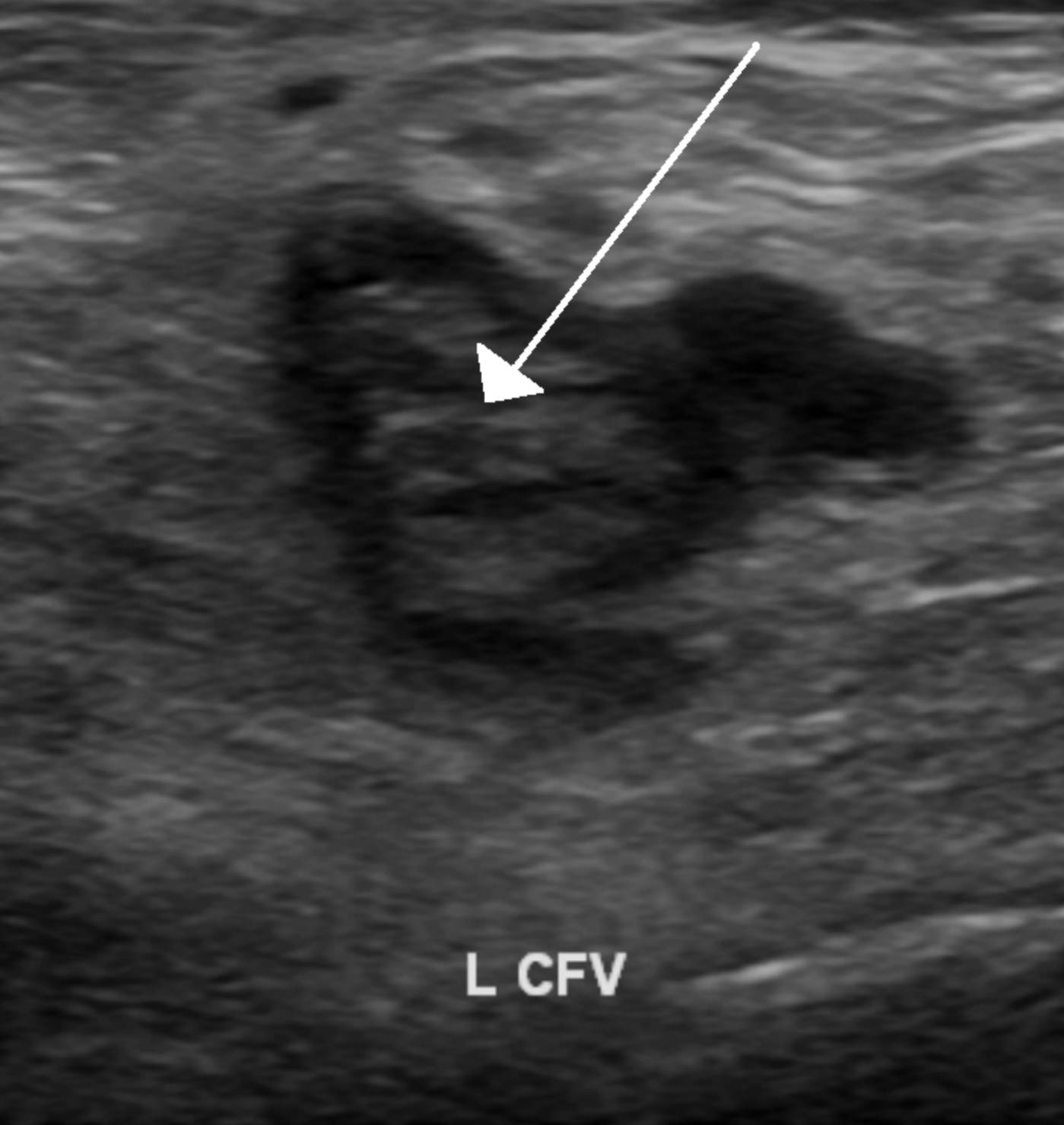 Ultrasound Diagnosis of Deep Vein Thrombosis in the Left Common Femoral Vein