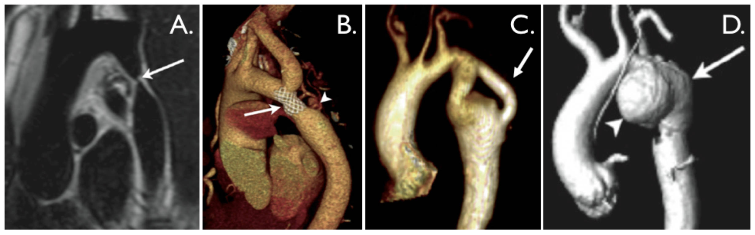 Aortic Coarctation: A Comprehensive Look Through Multi-Modality Imaging