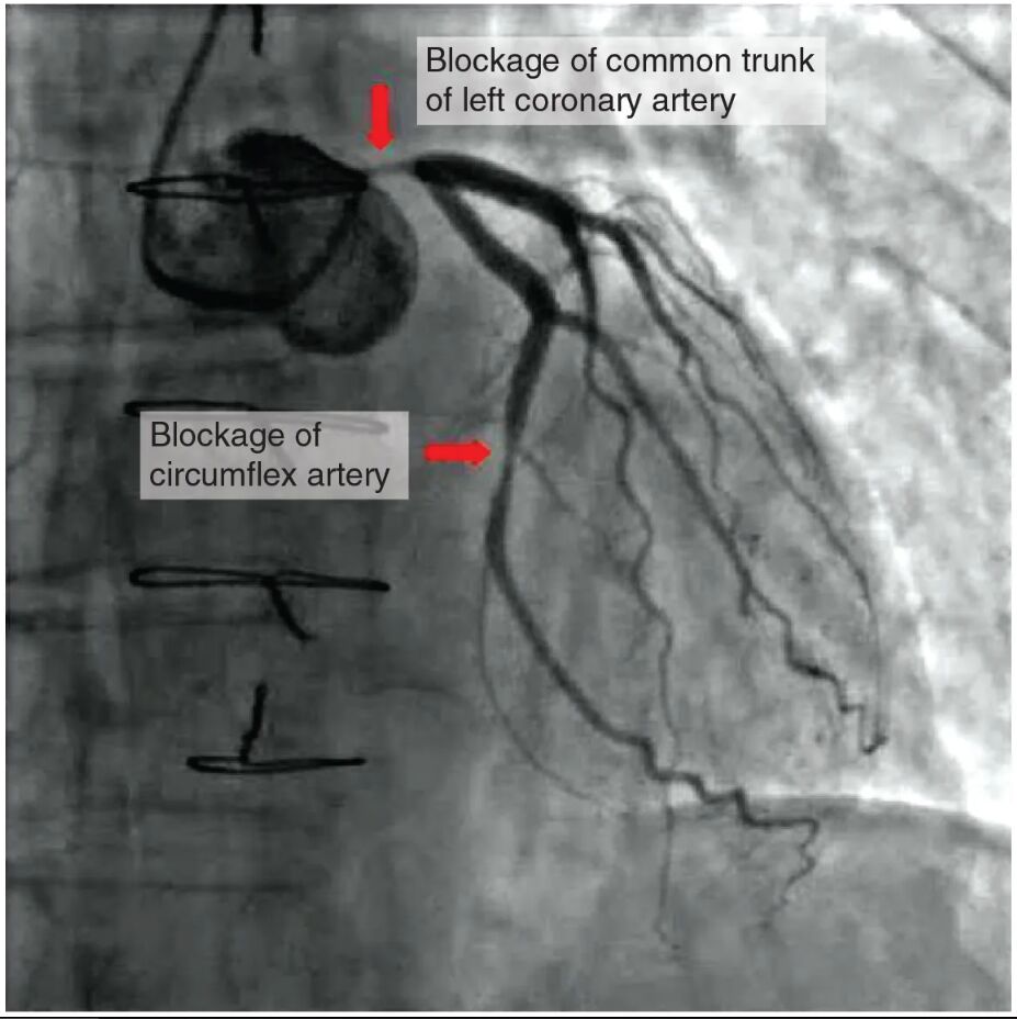 Atherosclerotic Coronary Arteries: Insights from Coronary Angiograms