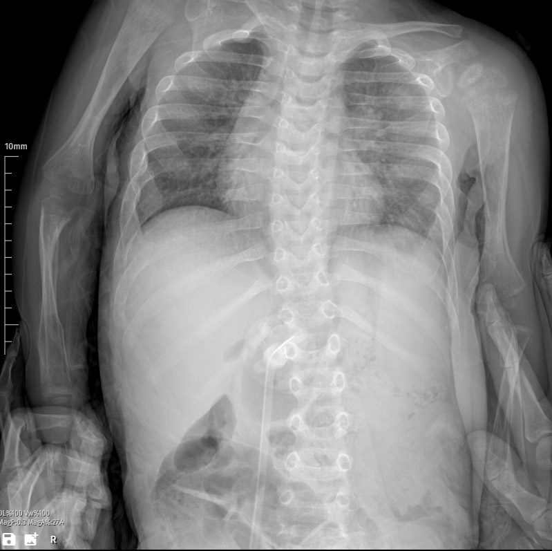 Bronchopulmonary dysplasia (BPD) X-ray image
