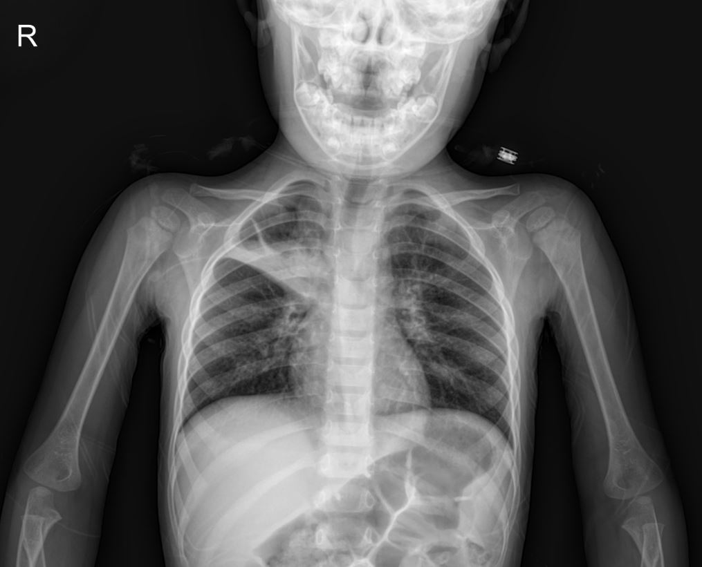 Case : A Case of Croup with Suspected Pneumonia and Incidental Hyperglycemia with X-ray