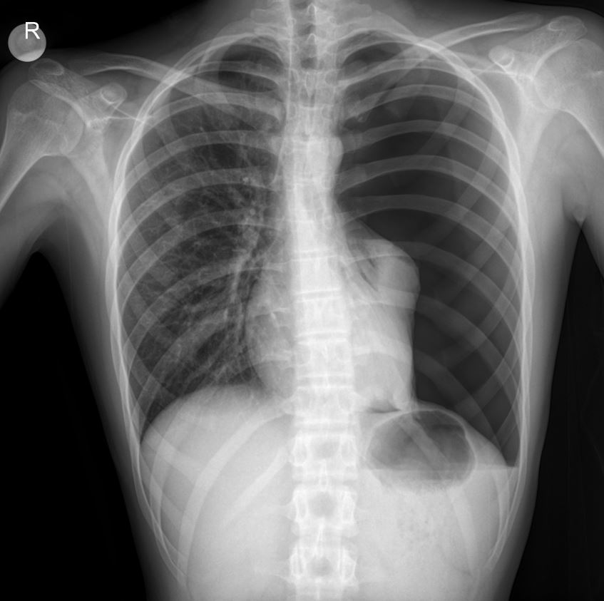 Case: Acute Chest Pain in Adolescence – A Case of Left Total Pneumothorax on X-ray