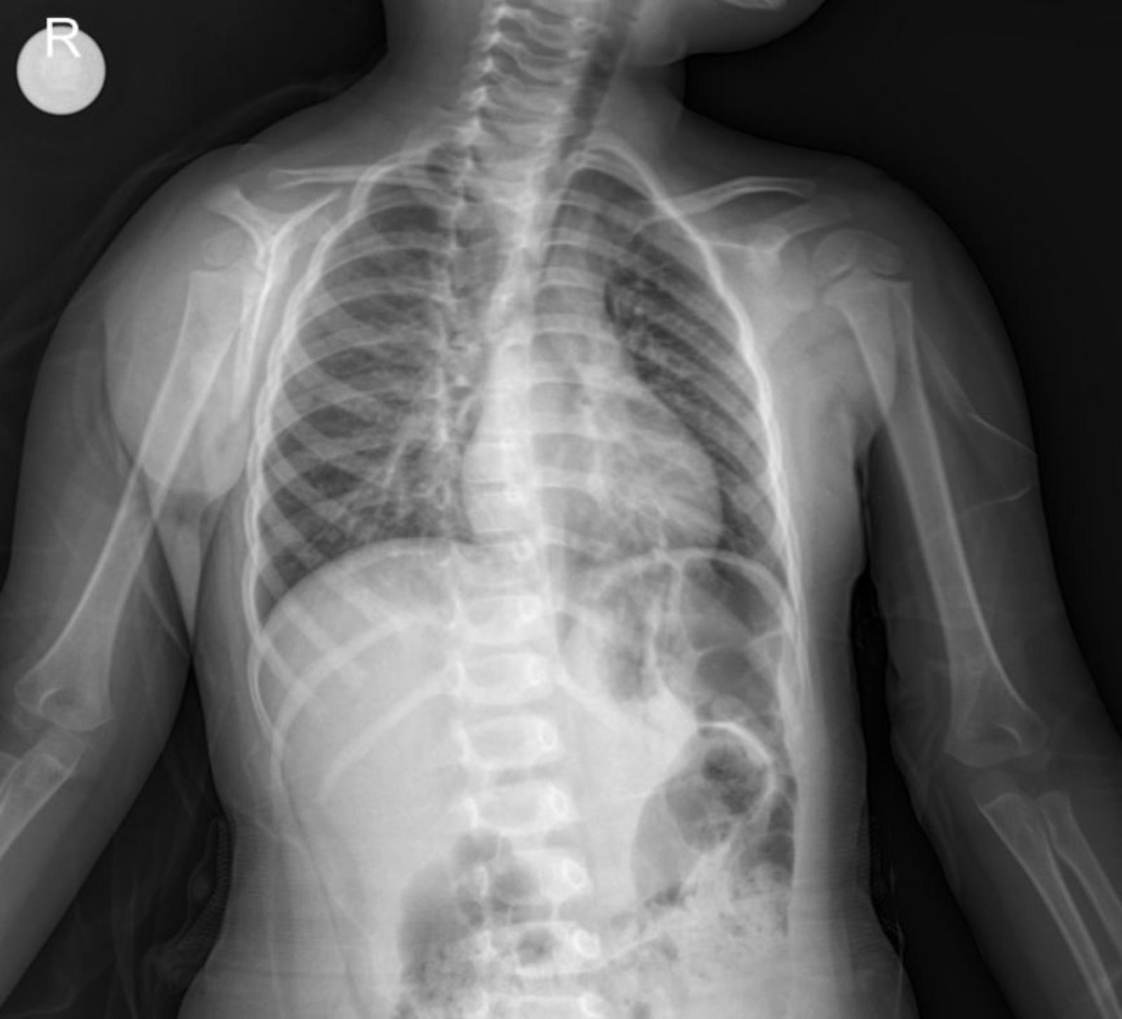 Case: Analyzing Pediatric Chest X-rays: A Case of Bronchopneumonia with Paracardial Infiltration