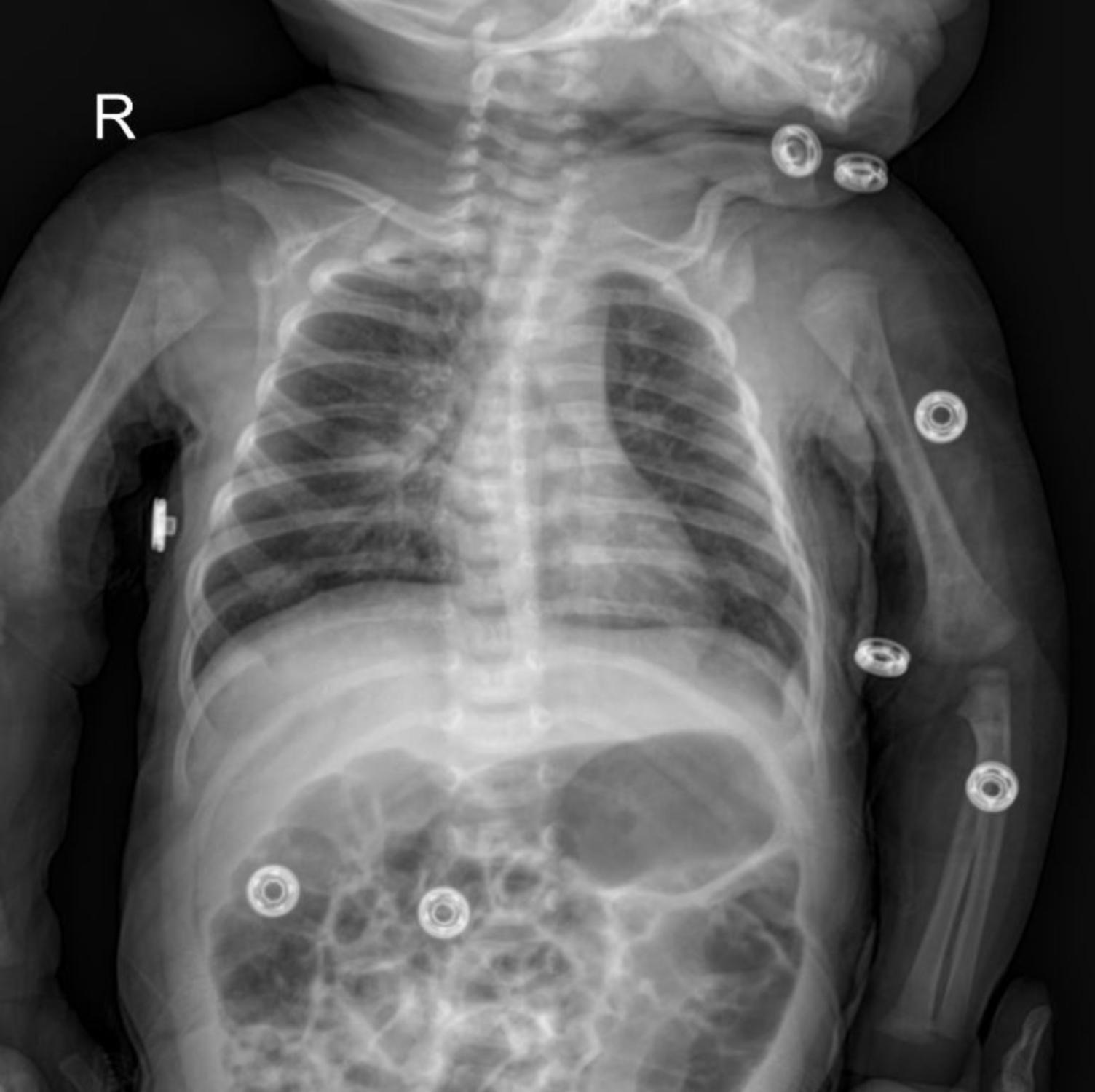 Case: Decoding the Shadows: A Pediatric Chest X-ray Case Study