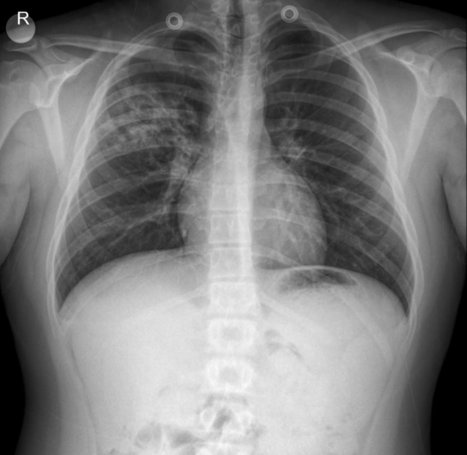 Case: Interpreting Thoracic X-rays in Adolescents: A Case of Right Upper-Mid Lobe Infiltration