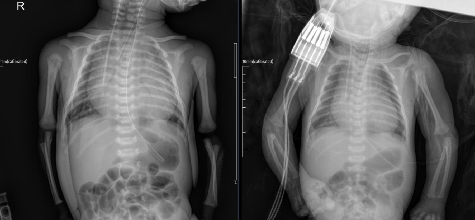 Case: Neonatal Dilated Cardiomyopathy: A Case Study with Evolving Chest X-ray Findings