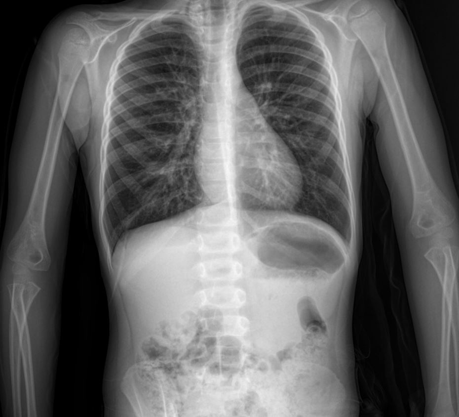 Case: Pediatric Asthma Exacerbation – A Case Study with Chest X-ray Analysis