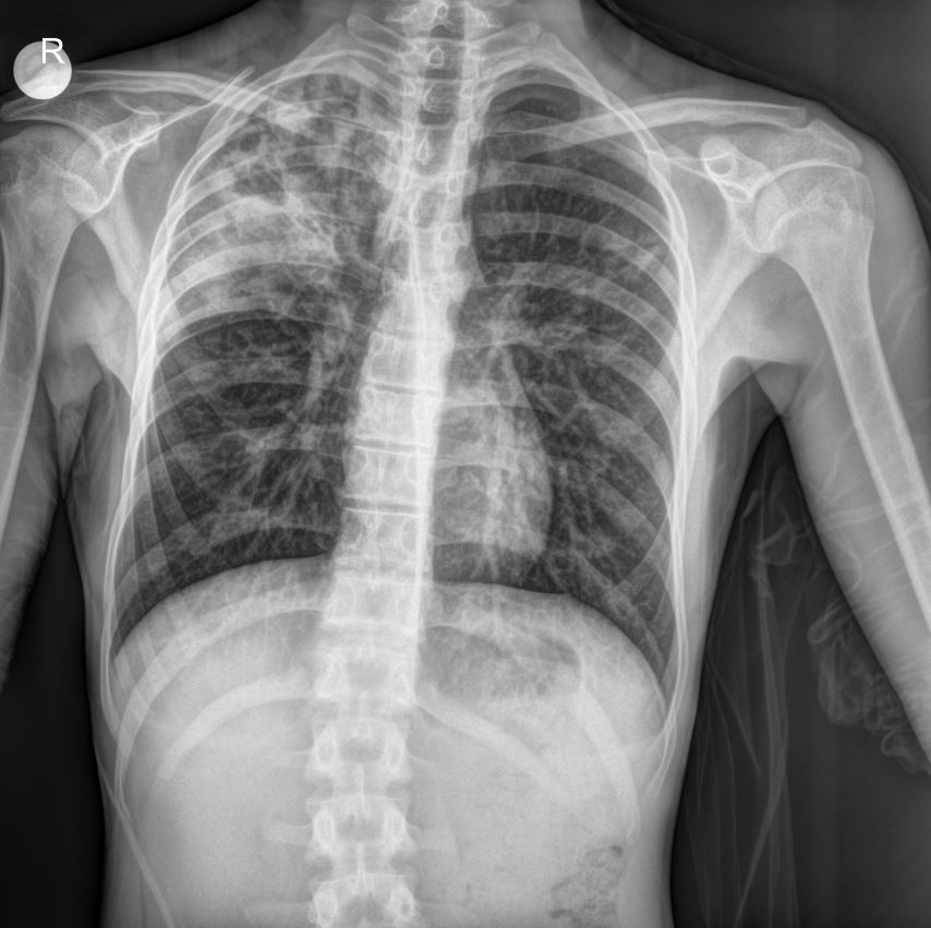Case: Pediatric Bronchopneumonia: A Case Study with X-ray Findings