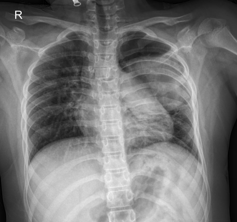 Pediatric Chest X-ray: Decoding a Large Cavitary Lung Lesion