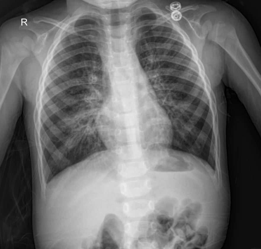 Case: Persistent Pneumonia or Tuberculosis? A Pediatric Chest X-Ray Case Analysis