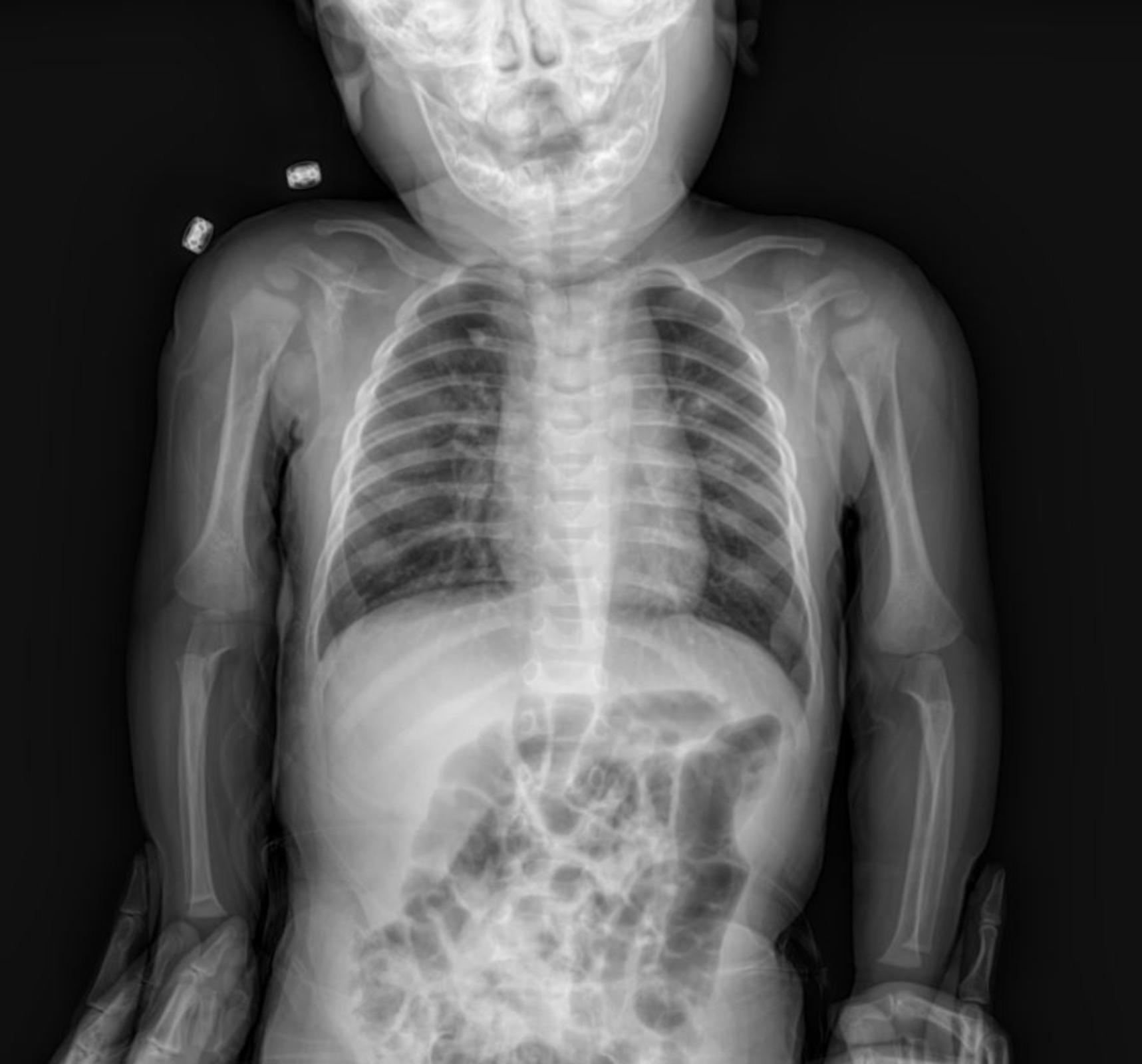 Case: Understanding Pediatric Thoracic with Paracardial infiltration X-rays