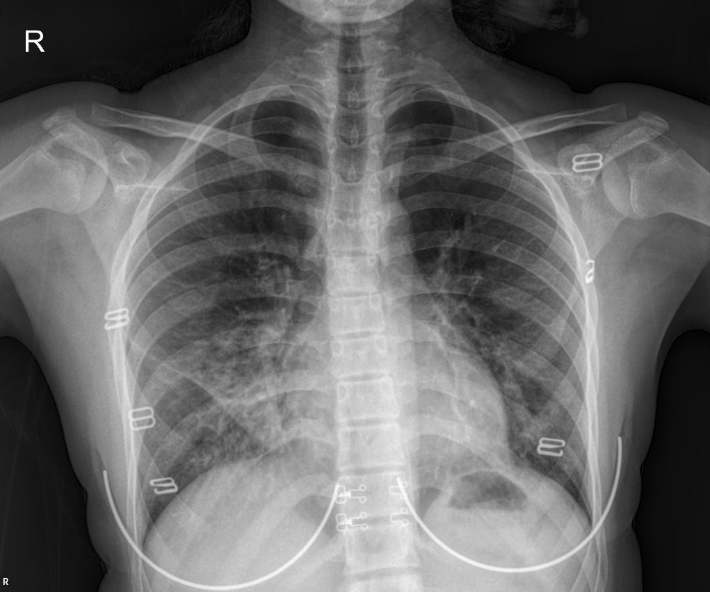 Case: Unraveling Recurrent Respiratory Distress: A Case Study with Chest X-ray and CT Findings