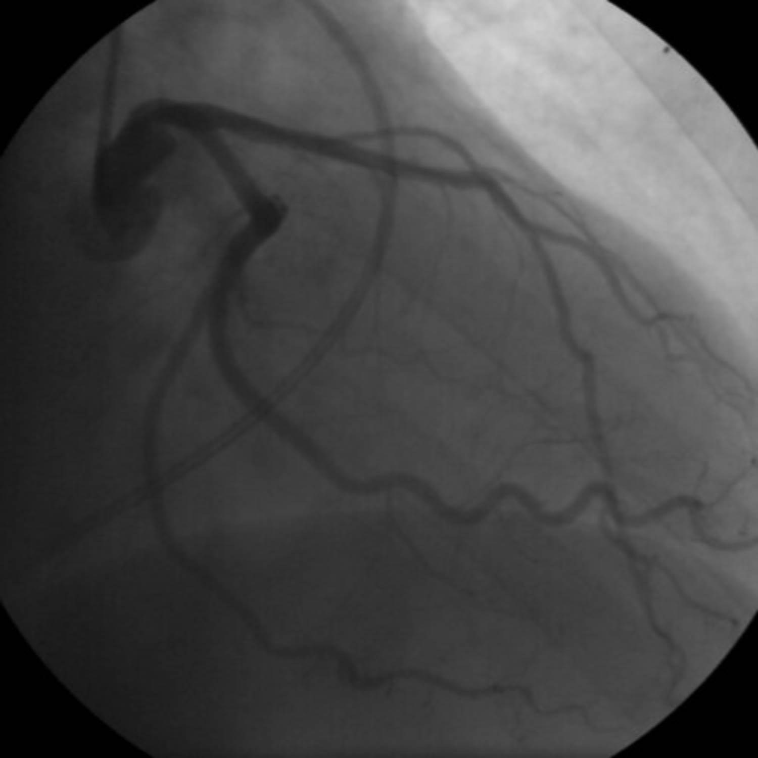 Unveiling Cardiac Health: A Look at a Female Coronary Angiogram