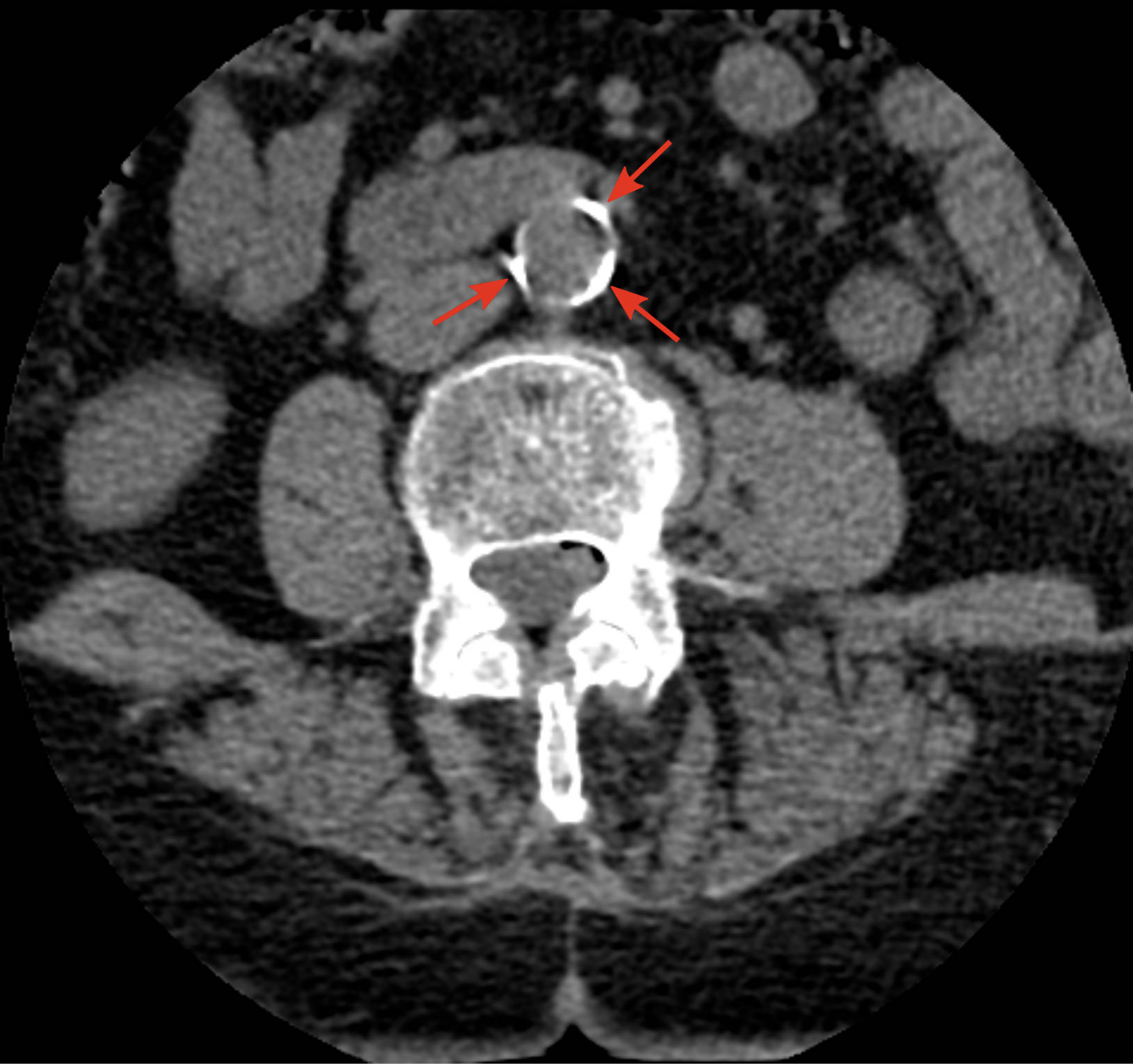 Understanding Abdominal Aortic Atherosclerosis with CT in a 70-Year-Old Woman