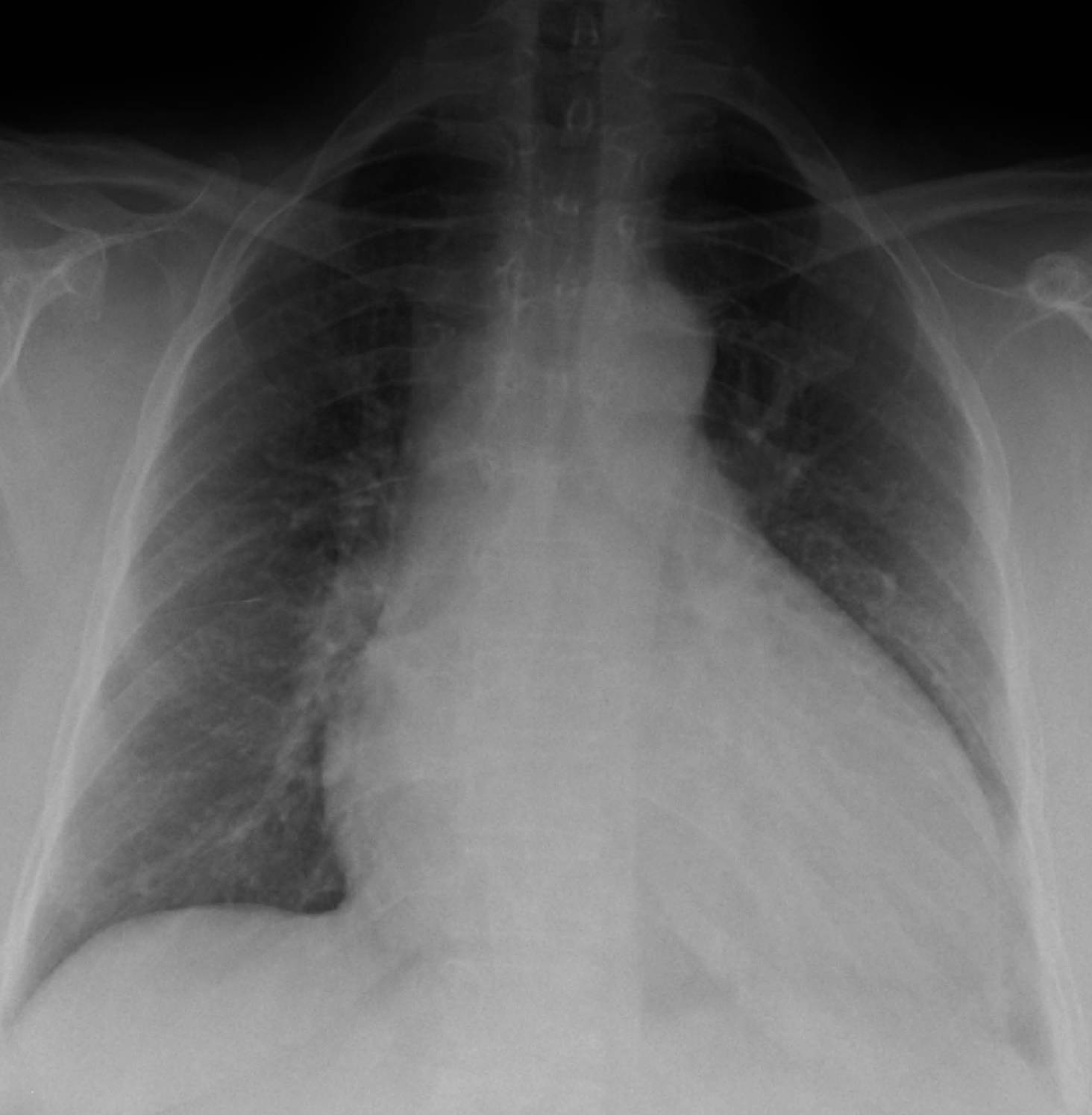Understanding Dilated Cardiomyopathy: Insights from a Chest X-Ray