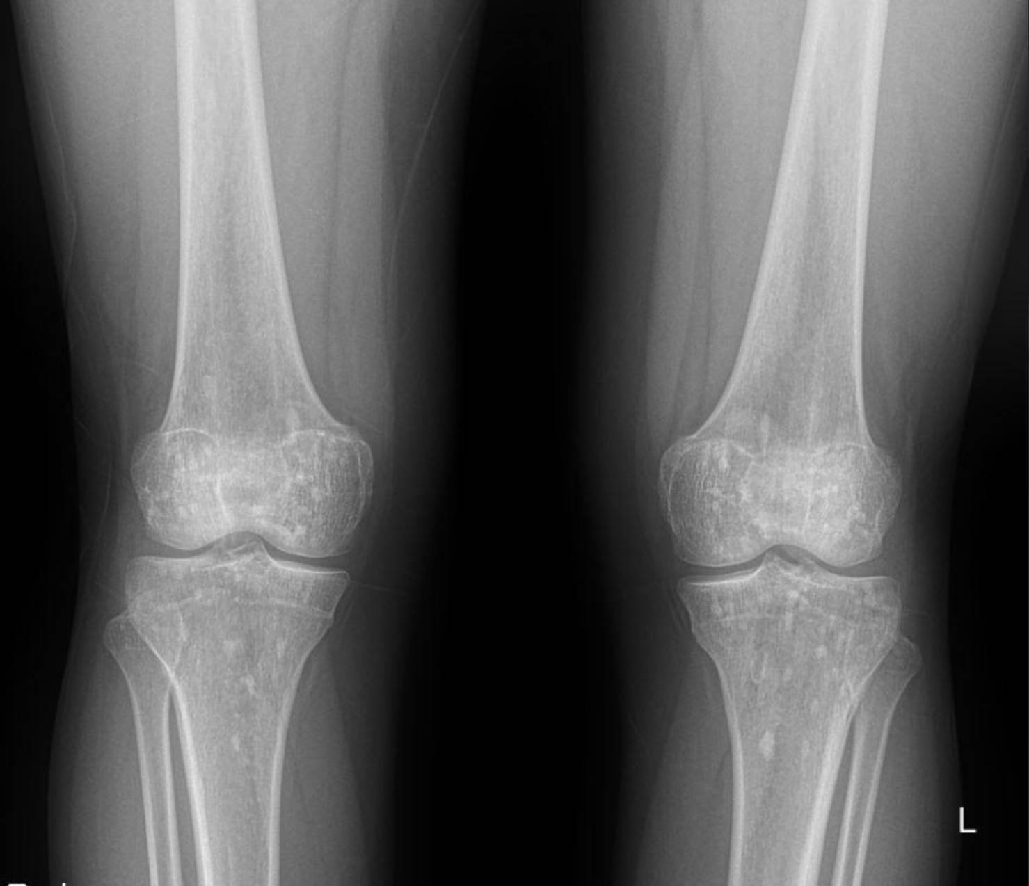 Case: Hereditary Osteopoikilosis X-ray: An Incidental Finding in a Case of Pediatric Renal Artery Stenosis