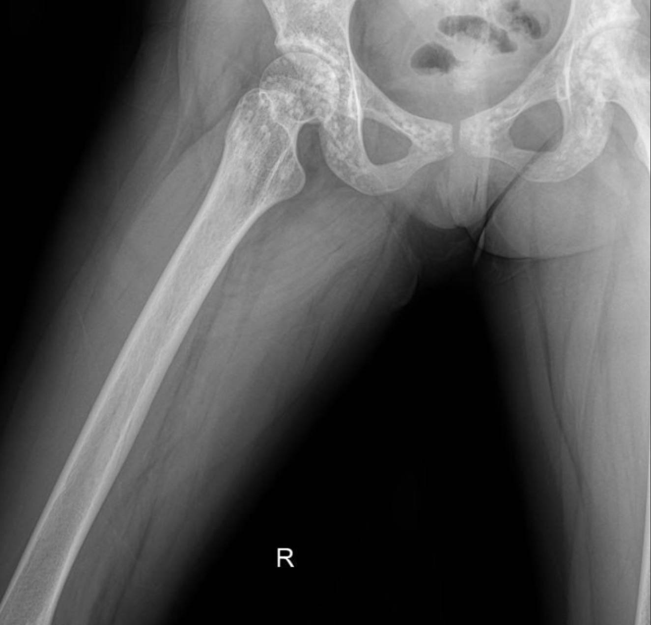 hereditary-osteopoikilosis-x-ray-femur Case: Hereditary Osteopoikilosis X-ray: An Incidental Finding in a Case of Pediatric Renal Artery Stenosis