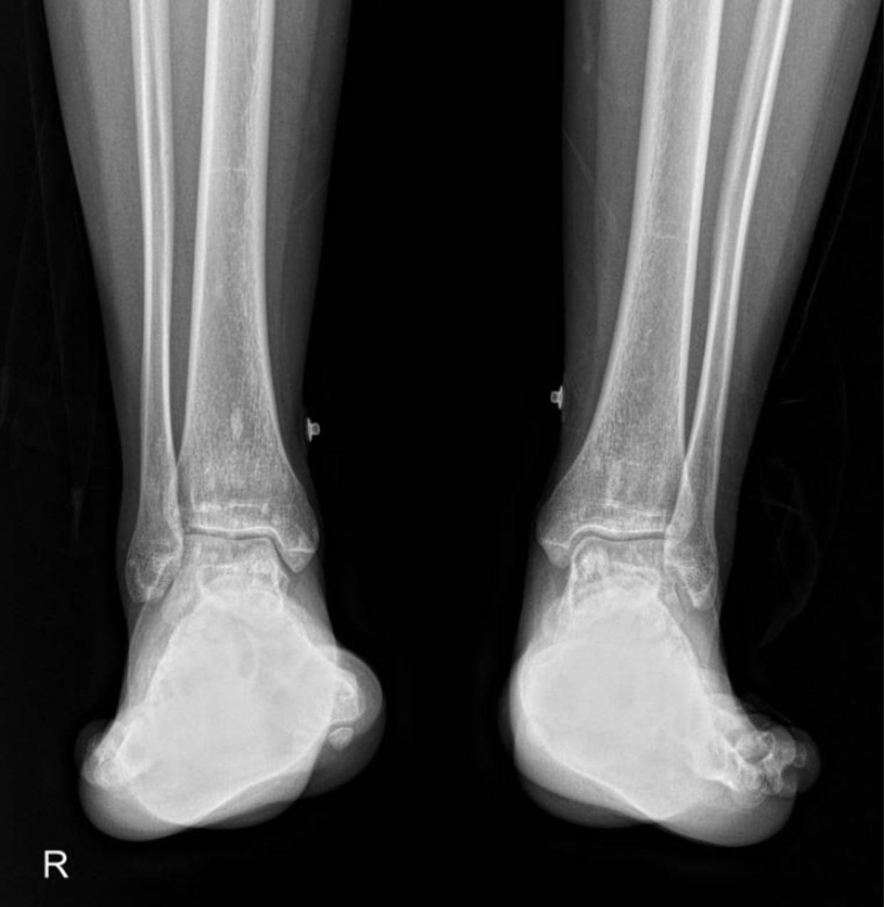 hereditary-osteopoikilosis-x-ray-foot-2 Case: Hereditary Osteopoikilosis X-ray: An Incidental Finding in a Case of Pediatric Renal Artery Stenosis