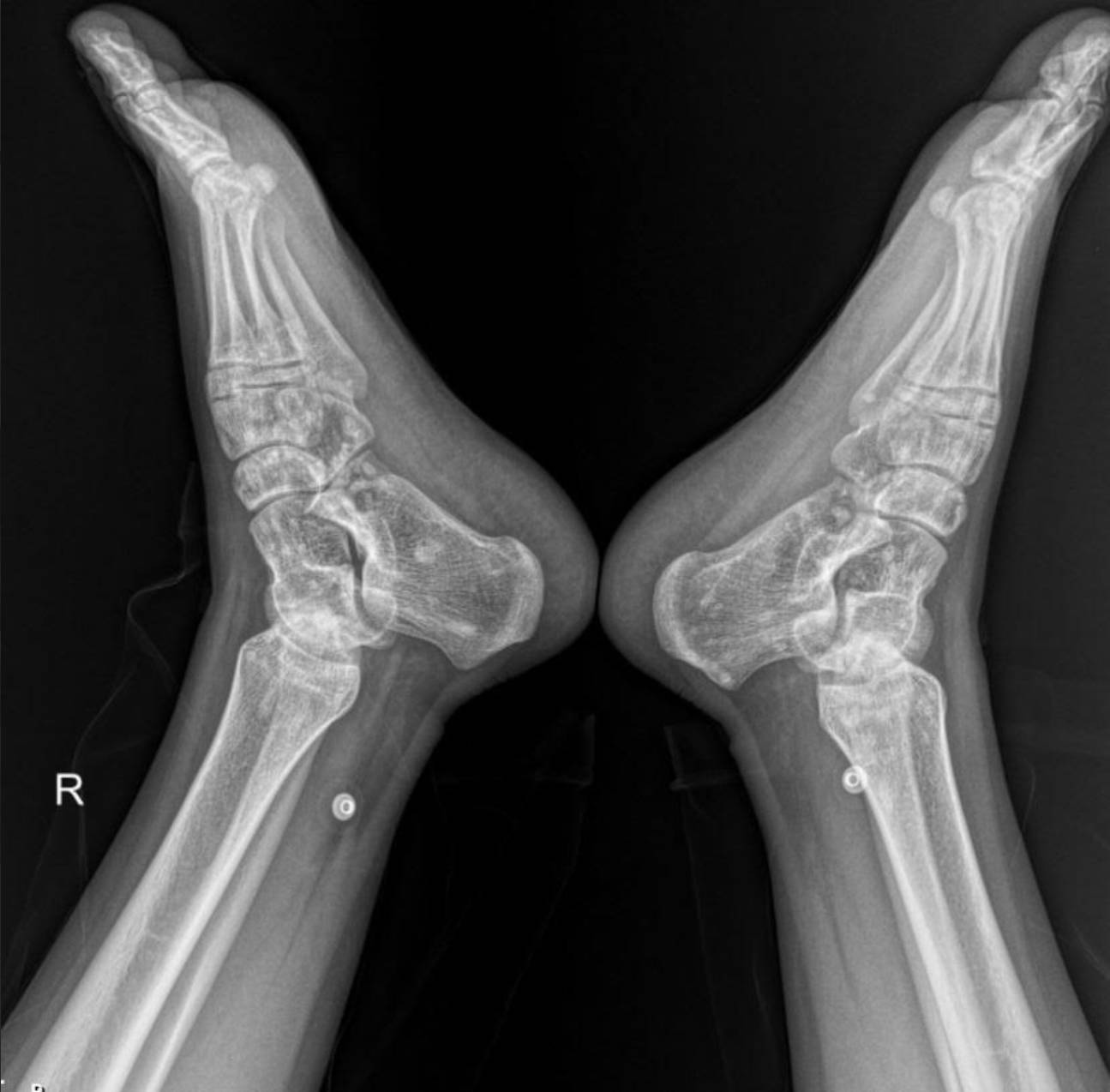 hereditary-osteopoikilosis-x-ray-foot Case: Hereditary Osteopoikilosis X-ray: An Incidental Finding in a Case of Pediatric Renal Artery Stenosis