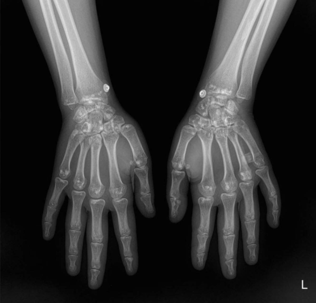 hereditary-osteopoikilosis-x-ray-hand Case: Hereditary Osteopoikilosis X-ray: An Incidental Finding in a Case of Pediatric Renal Artery Stenosis