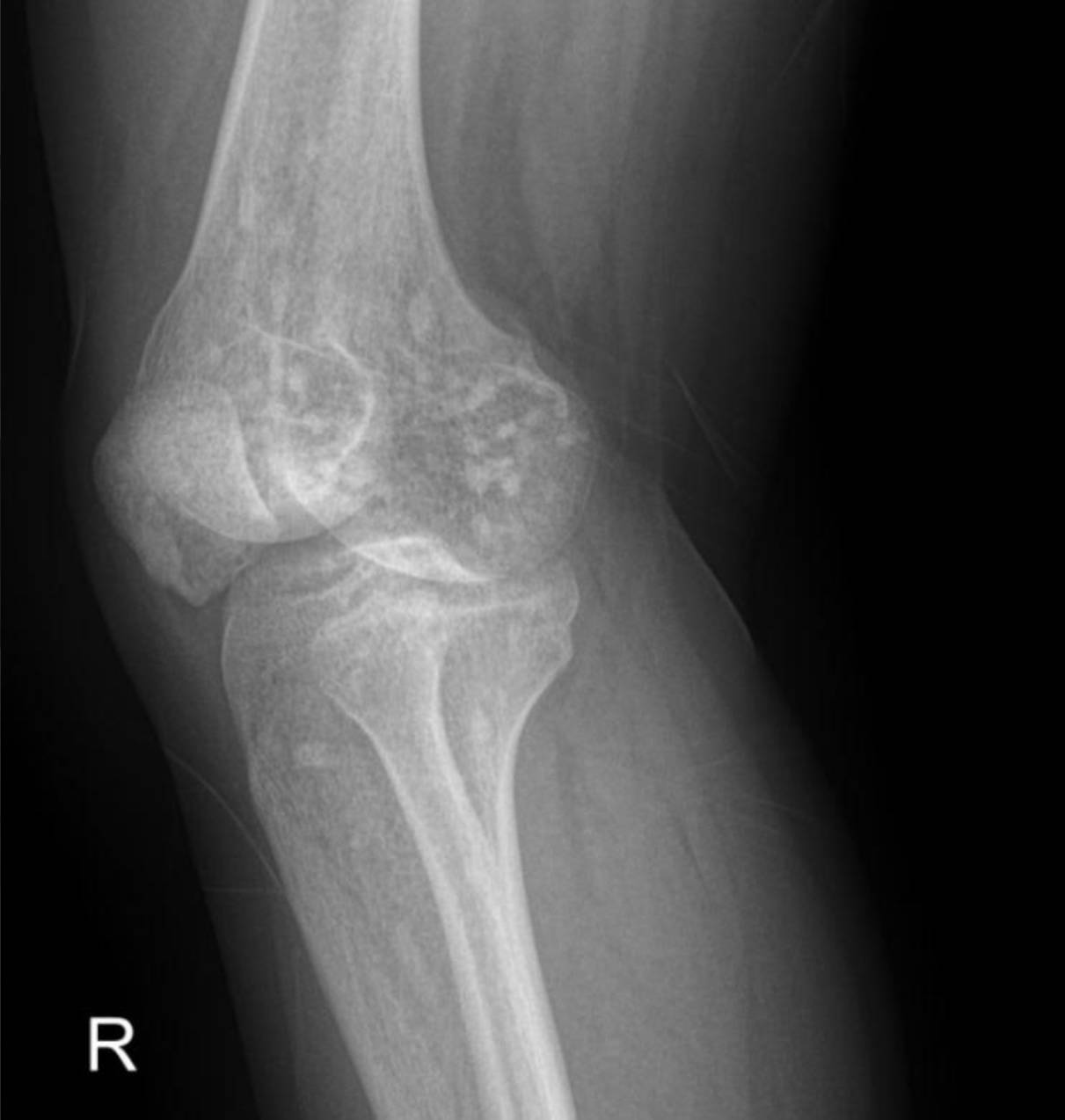 hereditary-osteopoikilosis-x-ray-knee-1 Case: Hereditary Osteopoikilosis X-ray: An Incidental Finding in a Case of Pediatric Renal Artery Stenosis