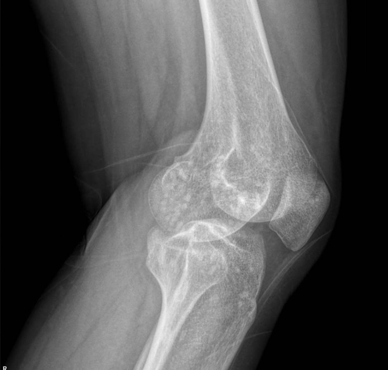 hereditary-osteopoikilosis-x-ray-knee-2 Case: Hereditary Osteopoikilosis X-ray: An Incidental Finding in a Case of Pediatric Renal Artery Stenosis