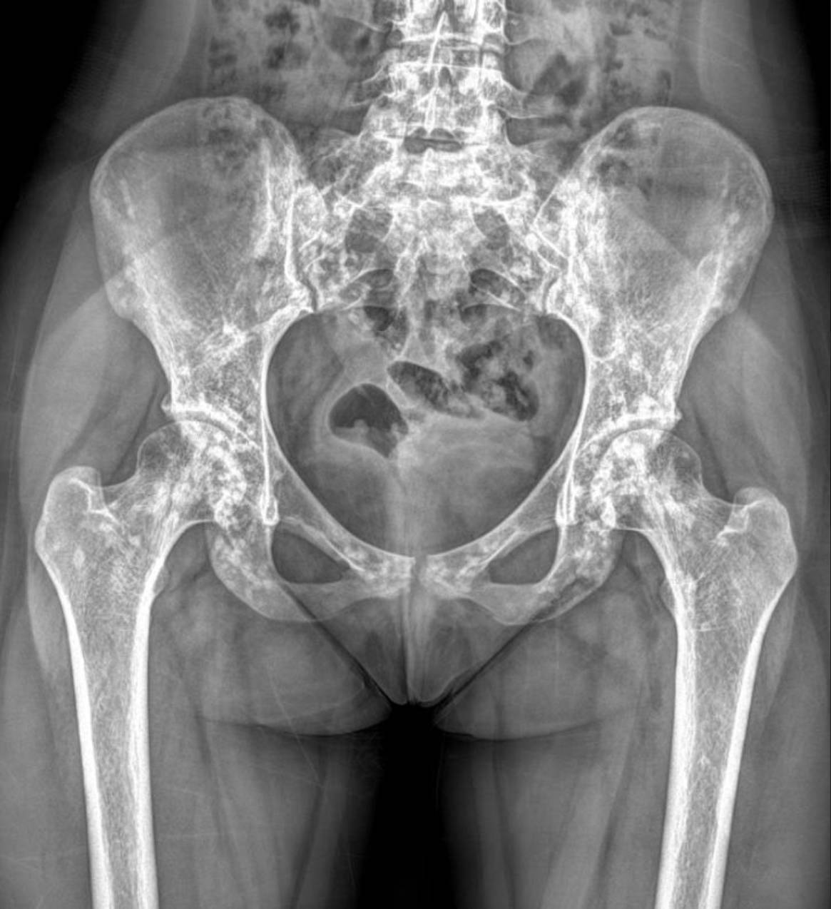 hereditary-osteopoikilosis-x-ray-pelvic Case: Hereditary Osteopoikilosis X-ray: An Incidental Finding in a Case of Pediatric Renal Artery Stenosis