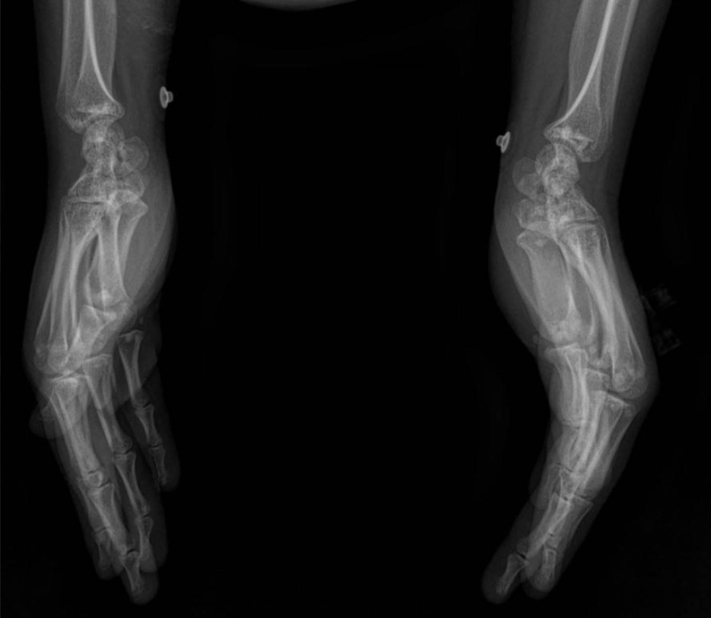 hereditary-osteopoikilosis-x-ray-wrist-lateral Case: Hereditary Osteopoikilosis X-ray: An Incidental Finding in a Case of Pediatric Renal Artery Stenosis