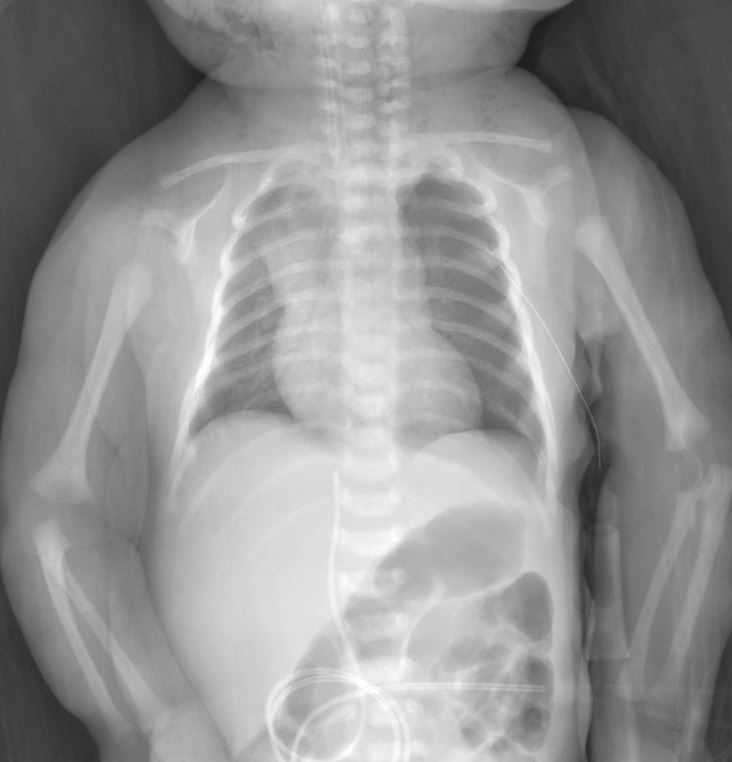 newborn-pneumothorax-after-chest-drain-insertion-2 Newborn Pneumothorax X-Ray Case: Left-Sided Diagnosis and Chest Drain Treatment in a Term Infant