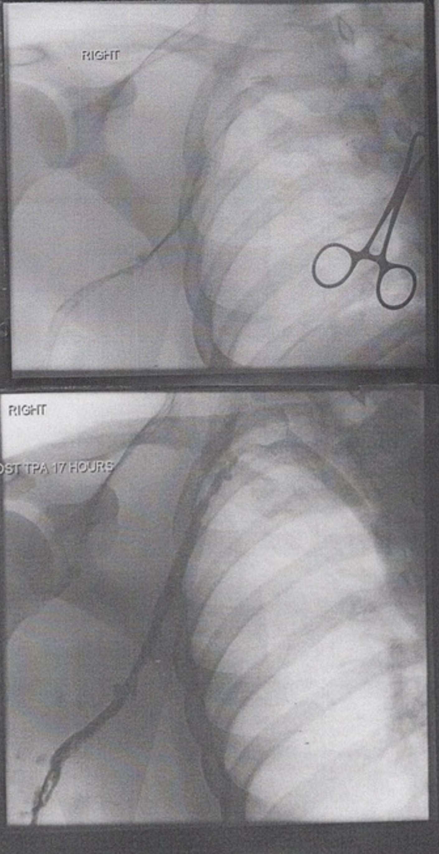 Venogram Case Study: Pre- and Post-Thrombolysis in Deep Vein Thrombosis