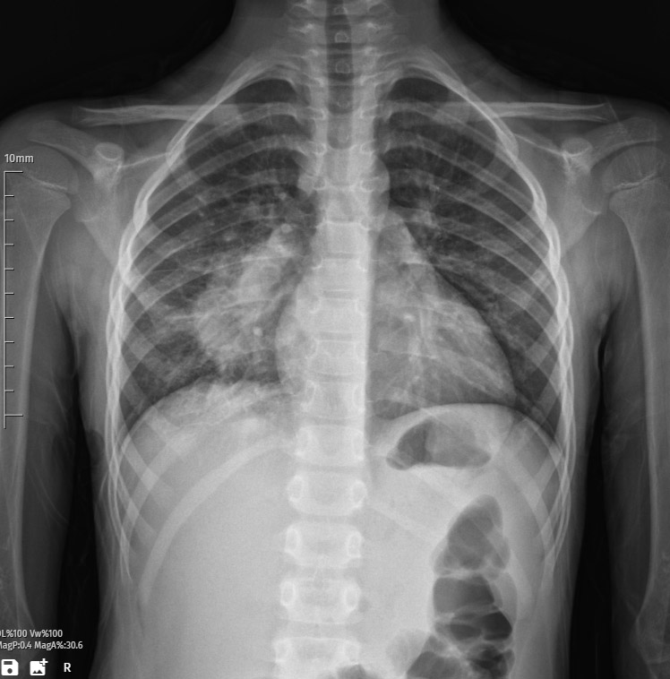 Pneumonia X-ray image summary, anatomy, findings, differential diagnosis and treatment