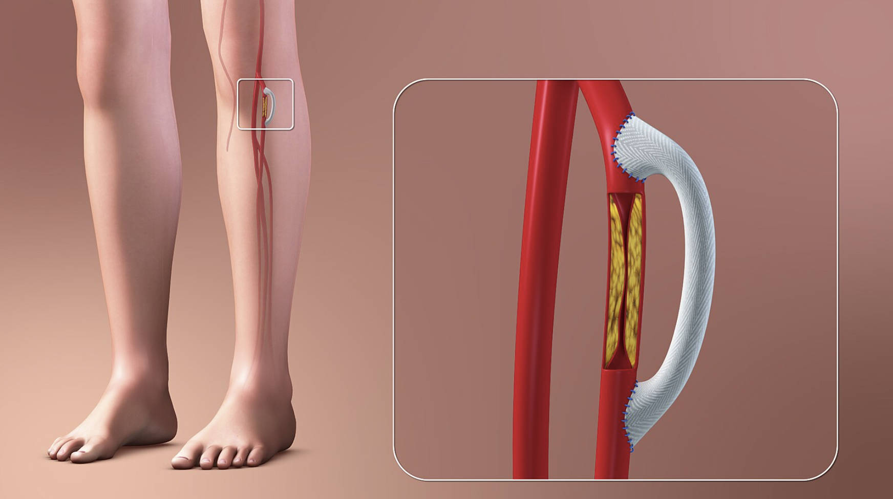 Vascular Bypass Grafting: Restoring Circulation in Peripheral Artery Disease