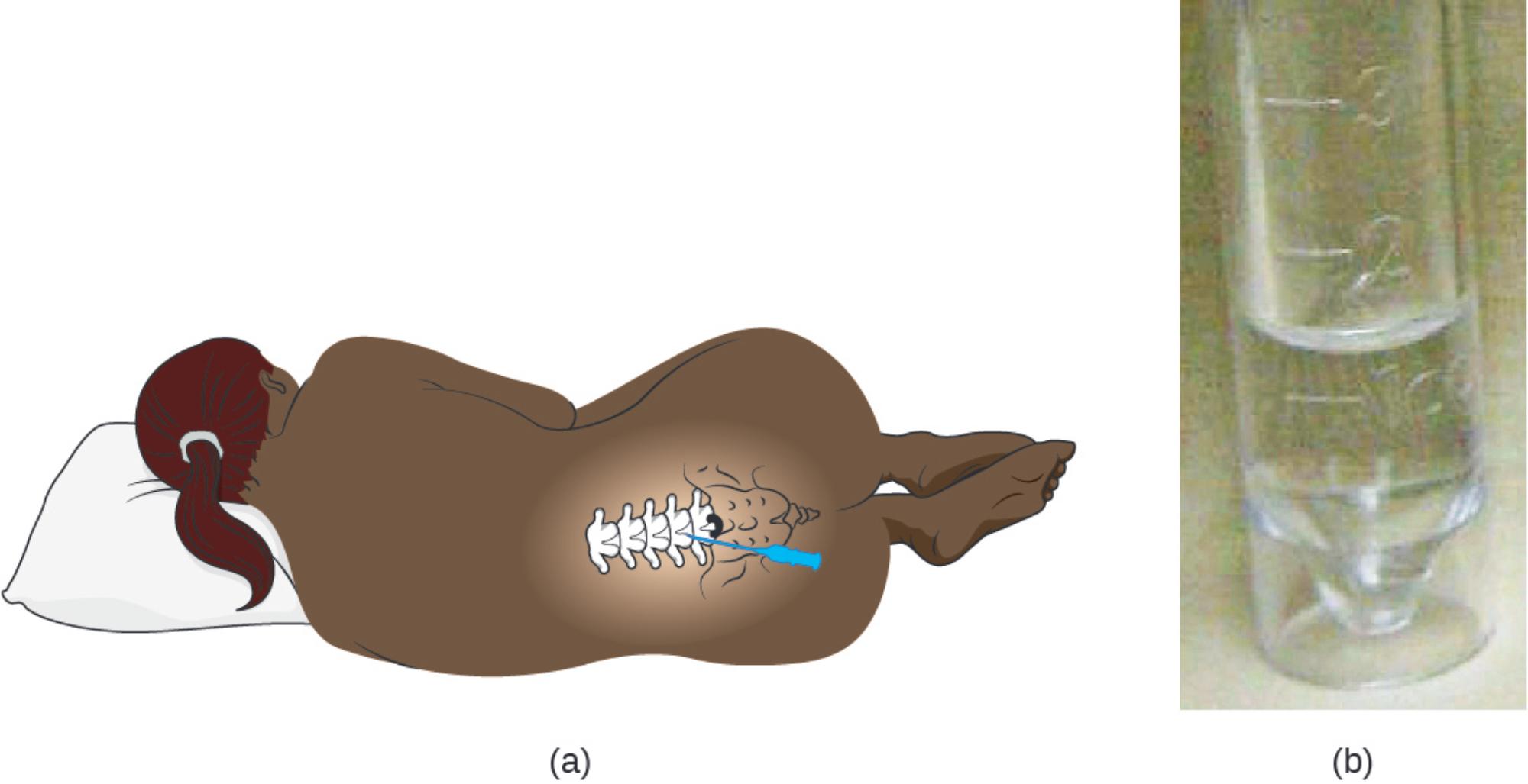 Lumbar Puncture and Cerebrospinal Fluid Analysis: Procedure and Clinical Significance
